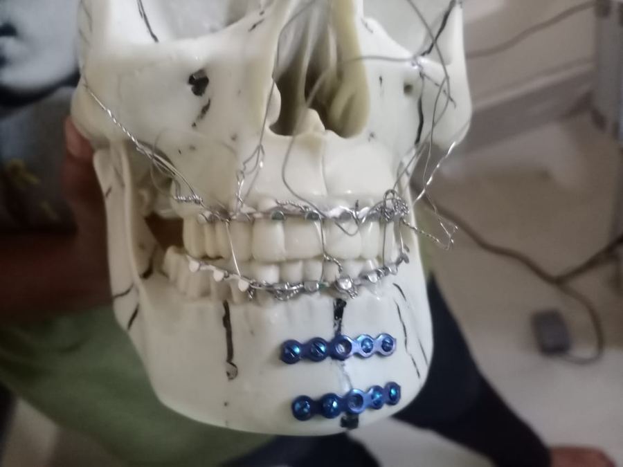 Skull plating demonstration